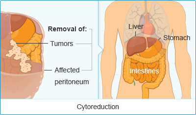 Mesothelioma Cytoreduction Surgery Treatment