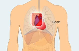 Pericardial Mesothelioma Body