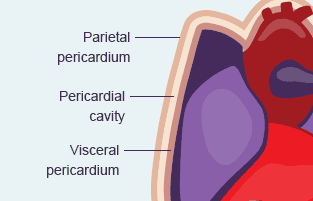 Pericardial Mesothelioma Heart