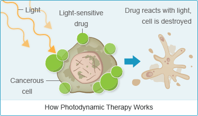Mesothelioma Photodynamic Therapy (PDT)  New Treatment