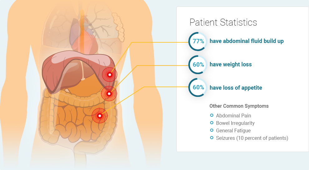 Peritoneal mesothelioma symptoms: 77% of patients have abdominal fluid build up (Ascites), 60% show weight loss, and 60% have a loss of appetite. Other common symptoms include abdominal pain, bowel irregularity, general fatigue, and seizures.