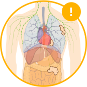 Diagram of Stage 1 Mesothelioma Cancer