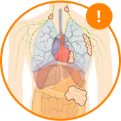 Diagram of Stage 2 Mesothelioma Cancer