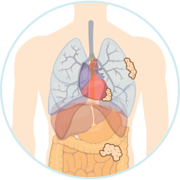 Stage 1 Mesothelioma Icon