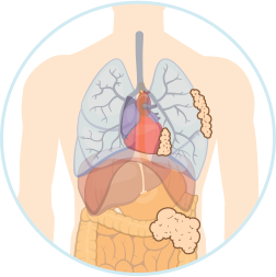 Stage 2 Mesothelioma Icon