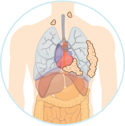 Stage 3 Mesothelioma Icon
