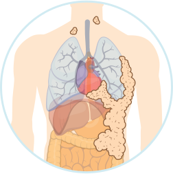 Stage 4 Mesothelioma Icon
