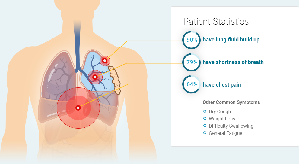 Pleural mesothelioma symptoms: 90% of patients have lung fluid build up, 79% have shortness of breath, and 64% have chest pain. Other common symptoms include dry cough, weight loss, difficulty swallowing and general fatigue.