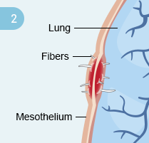 How Mesothelioma Develops: Step 2 Step 2: Mesothelium irritation