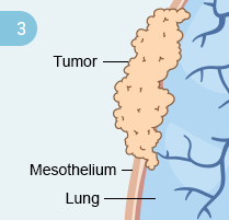 How Mesothelioma Develops: Step 3 Step 3: Development of Mesothelioma