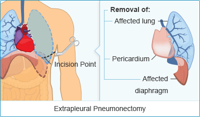 Mesothelioma Surgery Options Curative Pain Relief Treatments