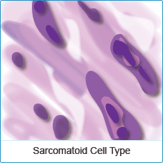 Sarcomatoid Mesothelioma Cell Type Sarcomatoid Mesothelioma Cell Type