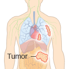 Stage 2 Mesothelioma