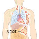 Stage 3 Mesothelioma
