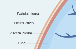 Areas of the lung that pleural mesothelioma develops and spreads Lungs showing the parietal pleural, pleural cavity, and visceral pleural where pleural mesothelioma develops