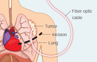 Intraoperative Photodynamic Therapy Intraoperative Photodynamic Therapy