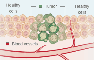Early Mesothelioma Tumor Development Pt. 1 Early Mesothelioma Tumor Development