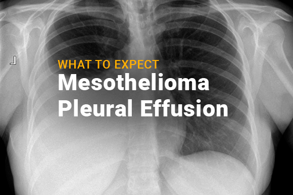 What To Expect When You Have Mesothelioma Pleural Effusion